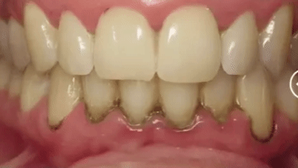 Flossat™ - Sluta BLÖDA börja FLOSSA