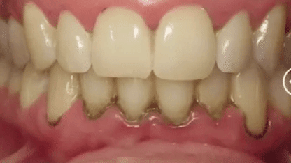 Flossat™ - Sluta BLÖDA börja FLOSSA